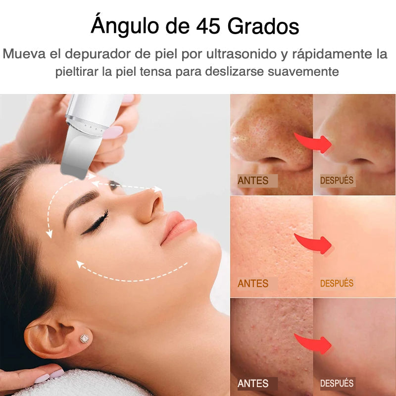 Exfoliador Ultrasónico Facial para Limpieza Profunda y Piel Más Suave y Radiante
